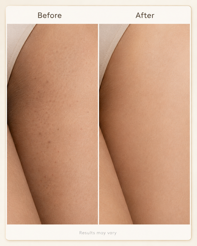 BBL Serum — Calmer, Clearer-Looking Bikini Line Skin in as Little as One Week